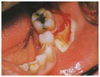auroh homeopathy abscess - dental abscess