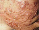 auroh homeopathy acne - acne conglobata