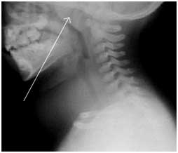 auroh homeopathy adenoid - adenoids in children