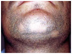 auroh homeopathy alopecia areata - alopecia areata barbae