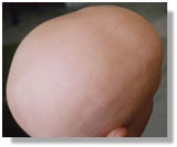 auroh homeopathy alopecia areata - alopecia areata totalis