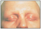 auroh homeopathy alopecia areata - alopecia areata universalis
