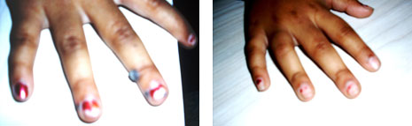 wart