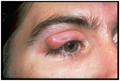 auroh homeopathy tarsal cyst or chalazion - chalazion