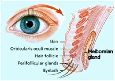 auroh homeopathy tarsal cyst or chalazion - tarsal cyst