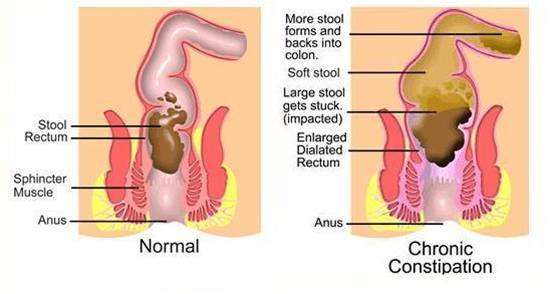 treatmrnt for constipation in homeopathy