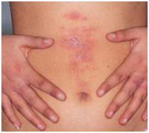 auroh homeopathy eczema - atopic dermatitis
