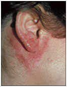 auroh homeopathy eczema - contact eczema
