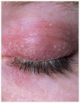 auroh homeopathy eczema - dyshidrotic eczema