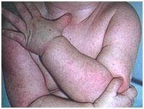 auroh homeopathy eczema - eczema in children