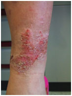 auroh homeopathy eczema - neuro dermatitis
