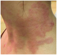auroh homeopathy eczema