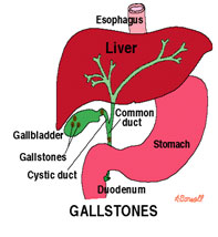 auroh homeopathy gallstones
