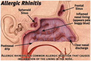 auroh homeopathy hay fever or allergic rhinitis