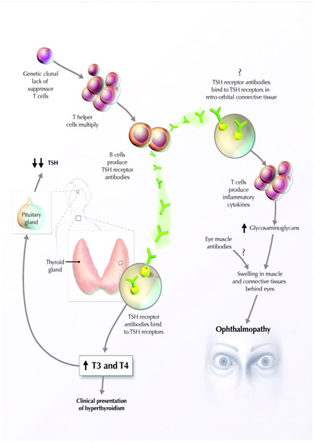 auroh homeopathy hyperthyroidism  - graves disease pathogenesis