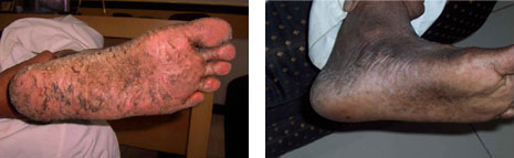 psoriasis-sole