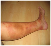 auroh homeopathy lichen planus - eczema
