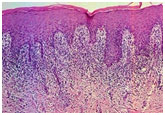 auroh homeopathy lichen planus - microscopic view of lichen