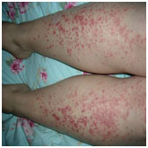 auroh homeopathy lichen planus - psoriasis