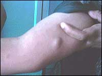 lipoma
