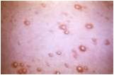 External hemorrhoid remedy hemorrhoids remedy