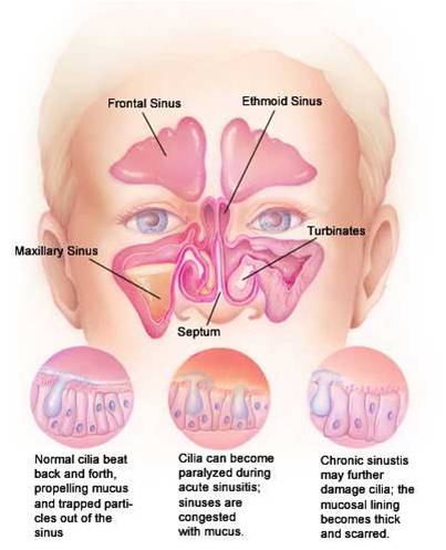 treatmrnt_for_nasalpolyps_in_homeopathy