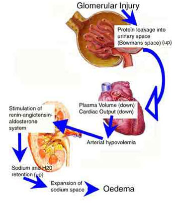 auroh homeopathy nephrotic syndrome