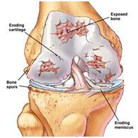 auroh homeopathy osteoarthritis