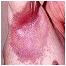 auroh homeopathy psoriasis - inverse psoriasis