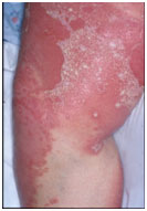 auroh homeopathy psoriasis - pustular psoriasis