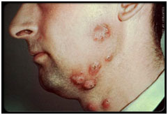 auroh homeopathy ringworm - tinea barbae