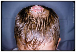 auroh homeopathy ringworm - tinea capitis