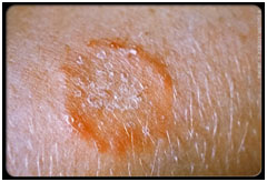 auroh homeopathy ringworm - tinea corporis