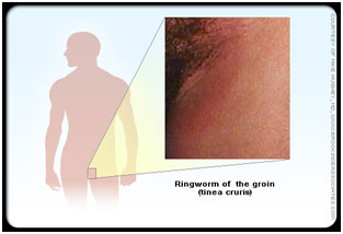 auroh homeopathy ringworm - tinea cruris
