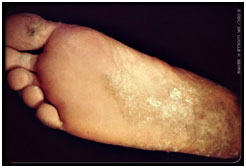 auroh homeopathy ringworm - tinea pedis