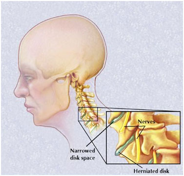 auroh homeopathy spondylitis - cervical spondylitis
