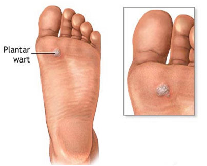 auroh homeopathy warts - plantar wart