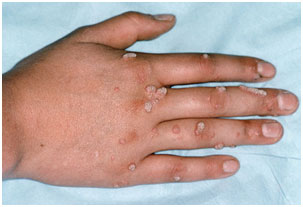 auroh homeopathy warts
