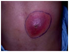 auroh homeopathy abscess - boils