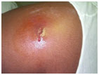 auroh homeopathy abscess - cutaneous abscess