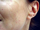 auroh homeopathy acne - acne cosmetica