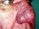 auroh homeopathy acne - acne rosacea