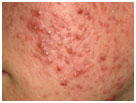 auroh homeopathy acne - acne vulgaris