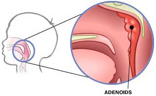 auroh homeopathy adenoid - adenoid hypertropy