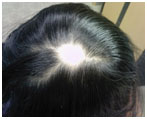 auroh homeopathy alopecia areata - alopecia areata monolocular