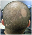 auroh homeopathy alopecia areata - alopecia areata multilocula