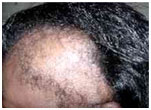 auroh homeopathy alopecia areata - traction alopecia