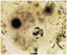 auroh homeopathy amoebiasis
