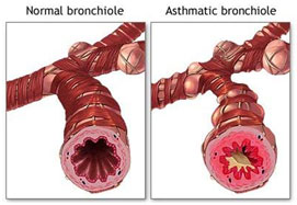 auroh homeopathy asthma - normal and asthmatic bronchiole