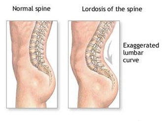 auroh homeopathy backache - normal spine and lordosis of the spine with exaggerated lumbar curve